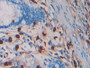 DAB staining on IHC-P; Samples: Human Colorectal cancer Tissue;  Primary Ab: 40µg/ml Mouse Anti-Huma