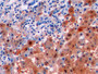 DAB staining on IHC-P; Samples: Human Liver cancer Tissue; Primary Ab: 10µg/ml Mouse Anti-Human Arg Antibody Second Ab: 2µg/mL HRP-Linked Caprine Anti-Mouse IgG Polyclonal Antibody