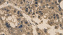 DAB staining on IHC-P; Samples: Human Liver cancer Tissue;  Primary Ab: 30µg/ml Mouse Anti-Human IL2 Antibody Second Ab: 2µg/mL HRP-Linked Caprine Anti-Mouse IgG Polyclonal Antibody 