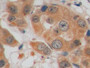 DAB staining on IHC-P; Samples: Human Breast cancer Tissue; Primary Ab: 10µg/ml Mouse Anti-Human GLUT1 Antibody Second Ab: 2µg/mL HRP-Linked Caprine Anti-Mouse IgG Polyclonal Antibody