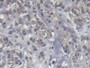 DAB staining on IHC-P; Samples: Human Breast cancer Tissue;  Primary Ab: 20µg/ml Mouse Anti-Human KI