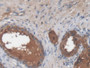 DAB staining on IHC-P; Samples: Human Prostate Tissue; Primary Ab: 20µg/ml Mouse Anti-Human LGALS3BP Antibody Second Ab: 2µg/mL HRP-Linked Caprine Anti-Mouse IgG Polyclonal Antibody