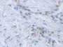 DAB staining on IHC-P; Samples: Human Colorectal cancer Tissue; Primary Ab: 30µg/ml Mouse Anti-Human RANk Antibody Second Ab: 2µg/mL HRP-Linked Caprine Anti-Mouse IgG Polyclonal Antibody