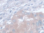 DAB staining on IHC-P; Samples: Human Breast cancer Tissue; Primary Ab: 30µg/ml Mouse Anti-Human AST Antibody Second Ab: 2µg/mL HRP-Linked Caprine Anti-Mouse IgG Polyclonal Antibody