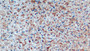 DAB staining on IHC-P; Samples: Human Liver Tissue; Primary Ab: 10µg/ml Mouse Anti-Human CTSD Antibody Second Ab: 2µg/mL HRP-Linked Caprine Anti-Mouse IgG Polyclonal Antibody