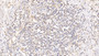 DAB staining on IHC-P; Samples: Human Endometrial cancer Tissue; Primary Ab: 10µg/ml Mouse Anti-Human Ub Antibody Second Ab: 2µg/mL HRP-Linked Caprine Anti-Mouse IgG Polyclonal Antibody