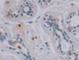DAB staining on IHC-P; Samples: Human Mammary gland Tissue; Primary Ab: 10µg/ml Mouse Anti-Human VEGF165 Antibody Second Ab: 2µg/mL HRP-Linked Caprine Anti-Mouse IgG Polyclonal Antibody