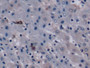 DAB staining on IHC-P; Samples: Human Liver cancer Tissue; Primary Ab: 10µg/ml Mouse Anti-Human VEGF165 Antibody Second Ab: 2µg/mL HRP-Linked Caprine Anti-Mouse IgG Polyclonal Antibody
