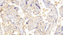 DAB staining on IHC-P; Samples: Human Placenta Tissue;  Primary Ab: 20μg/ml Mouse Anti-Human CGb Antibody Second Ab: 2µg/mL HRP-Linked Caprine Anti-Mouse IgG Polyclonal Antibody 