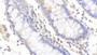 DAB staining on IHC-P; Samples: Human Colon Tissue; Primary Ab: 20μg/ml Rabbit Anti-Human Slit2 Antibody Second Ab: 2µg/mL HRP-Linked Caprine Anti-Rabbit IgG Polyclonal Antibody