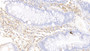 DAB staining on IHC-P; Samples: Human Colorectal cancer Tissue;  Primary Ab: 10ug/ml Rabbit Anti-Human EPCAM Antibody Second Ab: 2µg/mL HRP-Linked Caprine Anti-Rabbit IgG Polyclonal Antibody 