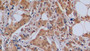 DAB staining on IHC-P; Samples: Human Breast cancer Tissue;  Primary Ab: 10µg/ml Rabbit Anti-Human CDKN1B Antibody Second Ab: 2µg/mL HRP-Linked Caprine Anti-Rabbit IgG Polyclonal Antibody 