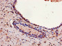 Immunohistochemistry of paraffin-embedded human prostate cancer using CAC07001 at dilution of 1:100