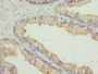 Immunohistochemistry of paraffin-embedded human prostate cancer using CAC07036 at dilution of 1:100