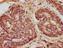 IHC image diluted at 1:100 and staining in paraffin-embedded human breast cancer performed on a Leica BondTM system. After dewaxing and hydration, antigen retrieval was mediated by high pressure in a citrate buffer (pH 6.0). Section was blocked with 10% normal goat serum 30min at RT. Then primary antibody (1% BSA) was incubated at 4°C overnight. The primary is detected by a biotinylated secondary antibody and visualized using an HRP conjugated SP system.