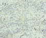 Immunohistochemistry of paraffin-embedded human breast cancer using CAC07046 at dilution of 1:100