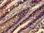 Immunohistochemistry of paraffin-embedded human colon cancer using CAC07100 at dilution of 1:100