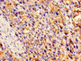 Immunohistochemistry of paraffin-embedded human liver cancer using CAC07107 at dilution of 1:100