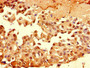 Immunohistochemistry of paraffin-embedded human breast cancer using CAC07111 at dilution of 1:100