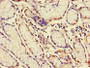 Immunohistochemistry of paraffin-embedded human gastric cancer using CAC07111 at dilution of 1:100
