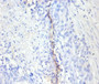 Immunohistochemistry of paraffin-embedded human bladder cancer using CAC07112 at dilution of 1:100