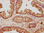 IHC image diluted at 1:500 and staining in paraffin-embedded human prostate cancer performed on a Leica BondTM system. After dewaxing and hydration, antigen retrieval was mediated by high pressure in a citrate buffer (pH 6.0). Section was blocked with 10% normal goat serum 30min at RT. Then primary antibody (1% BSA) was incubated at 4°C overnight. The primary is detected by a biotinylated secondary antibody and visualized using an HRP conjugated SP system.