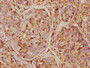 IHC image diluted at 1:500 and staining in paraffin-embedded human liver cancer performed on a Leica BondTM system. After dewaxing and hydration, antigen retrieval was mediated by high pressure in a citrate buffer (pH 6.0). Section was blocked with 10% normal goat serum 30min at RT. Then primary antibody (1% BSA) was incubated at 4°C overnight. The primary is detected by a biotinylated secondary antibody and visualized using an HRP conjugated SP system.