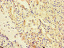 Immunohistochemistry of paraffin-embedded human lung cancer using CAC07197 at dilution of 1:100