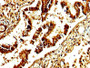 IHC image diluted at 1:250 and staining in paraffin-embedded human lung tissue performed on a Leica BondTM system. After dewaxing and hydration, antigen retrieval was mediated by high pressure in a citrate buffer (pH 6.0). Section was blocked with 10% normal goat serum 30min at RT. Then primary antibody (1% BSA) was incubated at 4°C overnight. The primary is detected by a biotinylated secondary antibody and visualized using an HRP conjugated SP system.