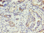 Immunohistochemistry of paraffin-embedded human lung cancer using CAC07209 at dilution of 1:100