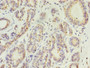 Immunohistochemistry of paraffin-embedded human breast cancer using CAC07209 at dilution of 1:100