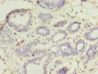 Immunohistochemistry of paraffin-embedded human breast cancer using CAC07242 at dilution of 1:100