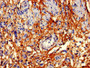 Immunohistochemistry of paraffin-embedded human bladder cancer using CAC07258 at dilution of 1:100