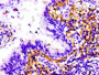 IHC image diluted at 1:100 and staining in paraffin-embedded human lung cancer performed on a Leica BondTM system. After dewaxing and hydration, antigen retrieval was mediated by high pressure in a citrate buffer (pH 6.0). Section was blocked with 10% normal goat serum 30min at RT. Then primary antibody (1% BSA) was incubated at 4°C overnight. The primary is detected by a biotinylated secondary antibody and visualized using an HRP conjugated SP system.