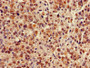 Immunohistochemistry of paraffin-embedded human glioma using CAC07297 at dilution of 1:100