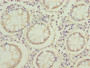 Immunohistochemistry of paraffin-embedded human colon cancer using CAC07300 at dilution of 1:100