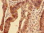Immunocytochemistry analysis of human colon cancer using CAC07319 at dilution of 1:100