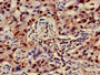 Immunohistochemistry of paraffin-embedded human lung cancer using CAC07345 at dilution of 1:100