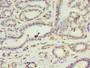 Immunohistochemistry of paraffin-embedded human breast cancer using CAC07347 at dilution of 1:100