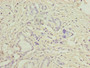 Immunohistochemistry of paraffin-embedded human pancreatic cancer using CAC07387 at dilution of 1:100