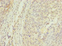 Immunohistochemistry of paraffin-embedded human cervical cancer using CAC07408 at dilution of 1:100