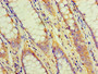 Immunohistochemistry of paraffin-embedded human colon cancer using CAC07491 at dilution of 1:100