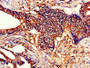 IHC image diluted at 1:200 and staining in paraffin-embedded human colon cancer performed on a Leica BondTM system. After dewaxing and hydration, antigen retrieval was mediated by high pressure in a citrate buffer (pH 6.0). Section was blocked with 10% normal goat serum 30min at RT. Then primary antibody (1% BSA) was incubated at 4°C overnight. The primary is detected by a biotinylated secondary antibody and visualized using an HRP conjugated SP system.