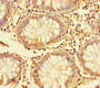 Immunohistochemistry of paraffin-embedded human colon cancer using CAC07500 at dilution of 1:100