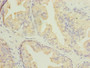 Immunohistochemistry of paraffin-embedded human prostate cancer using CAC07502 at dilution of 1:100