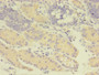 Immunohistochemistry of paraffin-embedded human gastric cancer using CAC07510 at dilution of 1:100