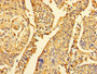 Immunohistochemistry of paraffin-embedded human cervical cancer using CAC07514 at dilution of 1:100