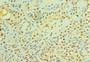 Immunohistochemistry of paraffin-embedded human breast cancer using CAC07532 at dilution of 1:100