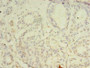 Immunohistochemistry of paraffin-embedded human breast cancer using CAC07563 at dilution of 1:100