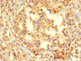Immunohistochemistry of paraffin-embedded human pancreatic cancer using CAC07617 at dilution of 1:100